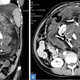 Un TAC del feto encontrado en el abdomen de la mujer
Imagen: Kumar, et al (BMJ Case Reports)